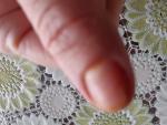 Болезь ногтя на руках грибок фото 3