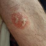 Как лечить красное пятно на ноге? фото 1