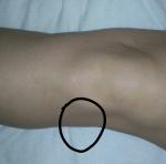 Шишка у сухожилия коленного сустава левой ноги фото 1