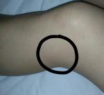 Шишка у сухожилия коленного сустава левой ноги фото 2