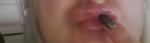 Фиброз губ или нет? фото 1