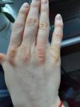 Желтизна и потрескивание кожи рук фото 2