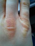 Желтизна и потрескивание кожи рук фото 1