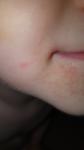 Мелкая Сыпь возле губ и на нижней губе фото 1