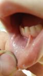 Мелкая Сыпь возле губ и на нижней губе фото 4