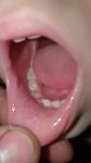 Мелкая Сыпь возле губ и на нижней губе фото 2