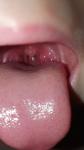 Мелкая Сыпь возле губ и на нижней губе фото 3