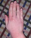 Воспаление кожи рук фото 1