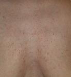 Красная сыпь на груди фото 1