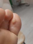Мозоль на пальце ноги, мешает( фото 1