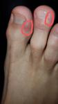 Покраснения на пальцах ног фото 3