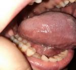 Проблемы с языком и горлом или это все таки рак фото 1