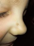 Пятно у ребенка на носу фото 1