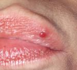 Красный нарост на губе фото 2