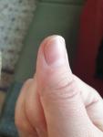 Красное пятно большого пальца руки фото 3