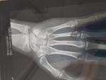 Открыты ли зоны роста по рентген снимкам кистей рук фото 4