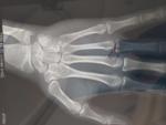 Открыты ли зоны роста по рентген снимкам кистей рук фото 3