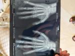 Открыты ли зоны роста по рентген снимкам кистей рук фото 1
