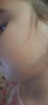 Высыпания на щеках у ребёнка 7 лет фото 1