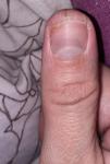 Трескается кожа около ногтя большого пальца руки фото 2