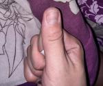 Трескается кожа около ногтя большого пальца руки фото 3