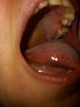 Припухлость с боку языка у корня фото 2