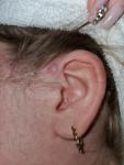 Воспаление возле уха фото 2