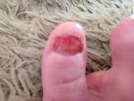 Долго заживает большой палец ноги после удаления ногтя фото 1