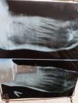Перелом 2,3,4,5 плюсневых костей фото 3