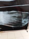 Перелом 2,3,4,5 плюсневых костей фото 2