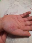 Аллергия или грибок на руках и ногтях у ребенка 4 лет фото 3