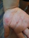 Аллергия или грибок на руках и ногтях у ребенка 4 лет фото 4