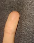 Хрустит палец руки при сгибании после иссечение шишки фото 1