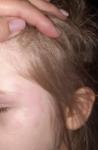 Аллергия у ребенка, красные пятна фото 1