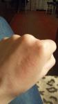 Сыпь на левой руке после перенесенного коронавируса зуд гормональные мази фото 1
