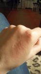 Сыпь на левой руке после перенесенного коронавируса зуд гормональные мази фото 3