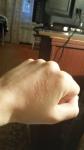 Сыпь на левой руке после перенесенного коронавируса зуд гормональные мази фото 2