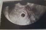 Беременность 6 недель и выделения фото 2