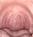 Заболевание горла болей нет ощущения комка в горле фото 5