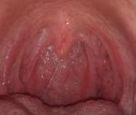 Заболевание горла болей нет ощущения комка в горле фото 4