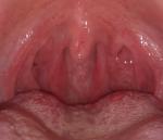 Заболевание горла болей нет ощущения комка в горле фото 3