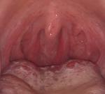 Заболевание горла болей нет ощущения комка в горле фото 2