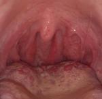 Заболевание горла болей нет ощущения комка в горле фото 1
