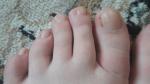 Пятно и грибок ногтевой пластины на ногах фото 1