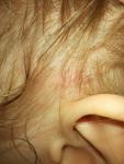 Сыпь на голове у ребенка фото 3
