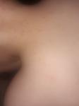 Сыпь на теле потница или аллергия фото 2