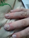 Покраснение на пальце и ногте фото 1