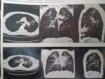Хронический бронхит или туберкулез фото 2