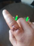 Резаная рана пальца фото 1