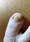 Заболевание ногтевой пластины большого пальца ноги фото 1